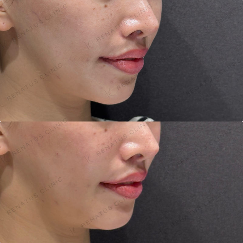 頬コケ・頬ヒアルロン酸ボリフト・ボリューマ症例写真