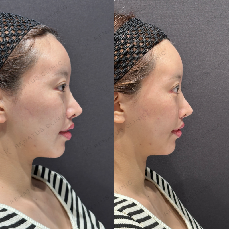 頬コケ・頬ヒアルロン酸ボリフト・ボリューマ症例写真