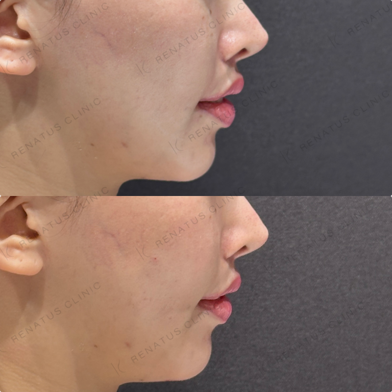 頬コケ・頬ヒアルロン酸ボリフト・ボリューマ症例写真