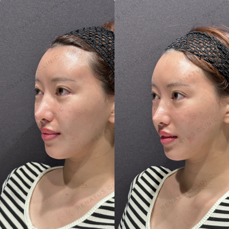 頬コケ・頬ヒアルロン酸ボリフト・ボリューマ症例写真