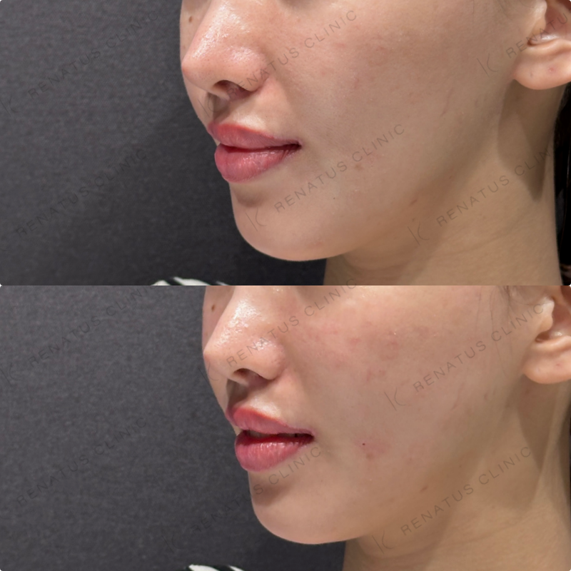 頬コケ・頬ヒアルロン酸ボリフト・ボリューマ症例写真