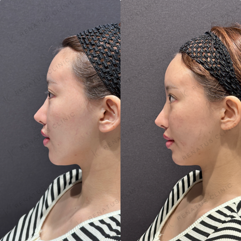 頬コケ・頬ヒアルロン酸ボリフト・ボリューマ症例写真