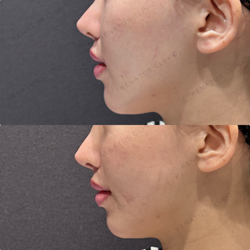 頬コケ・頬ヒアルロン酸ボリフト・ボリューマ症例写真