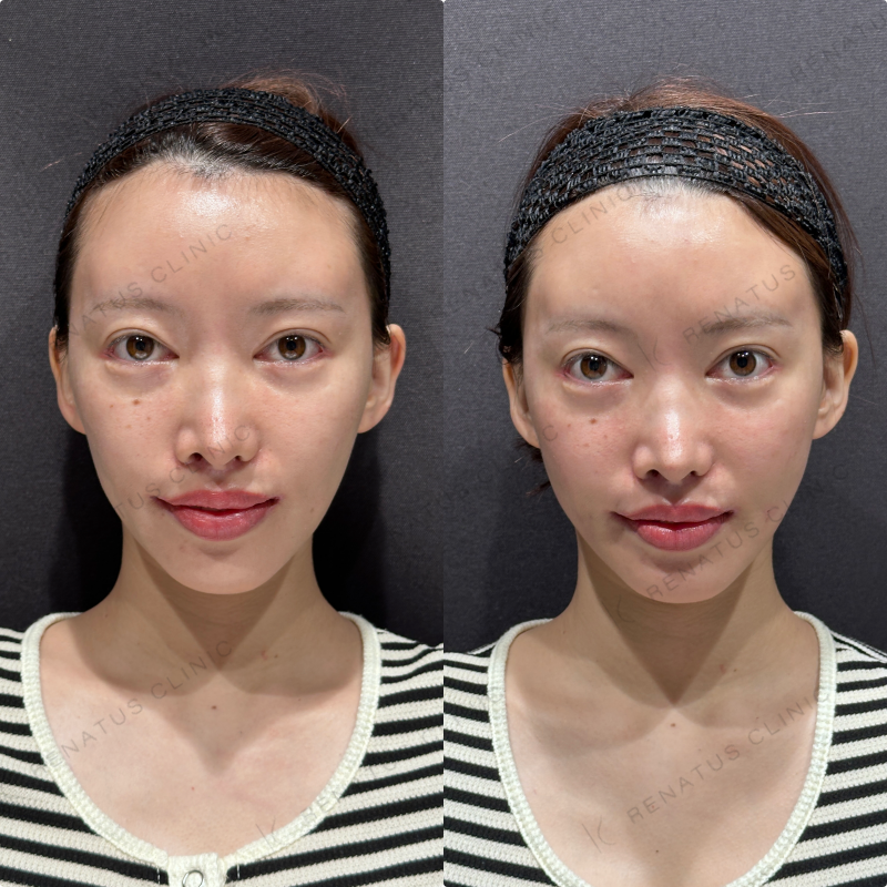 頬コケ・頬ヒアルロン酸ボリフト・ボリューマ症例写真