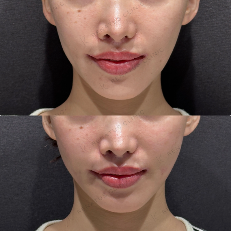 頬コケ・頬ヒアルロン酸ボリフト・ボリューマ症例写真