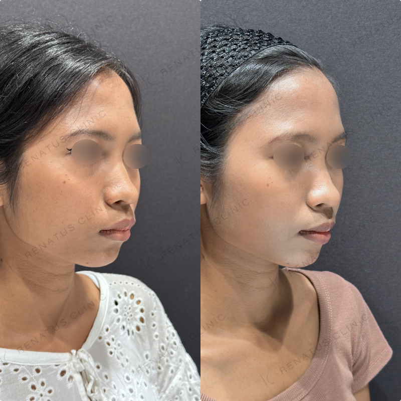 頬コケヒアルロン酸ボライト症例写真