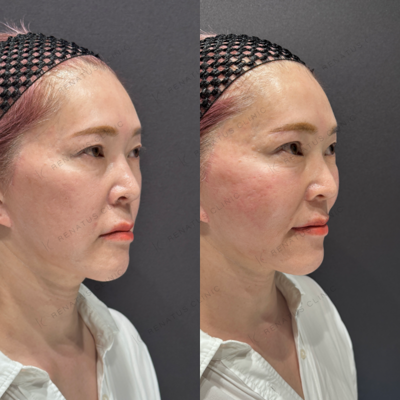 頬コケヒアルロン酸ボライト症例写真