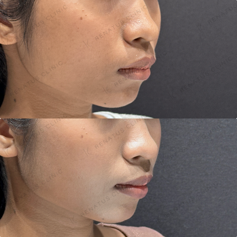 頬コケヒアルロン酸ボライト症例写真