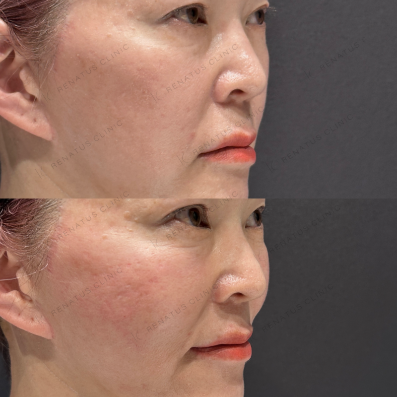 頬コケヒアルロン酸ボライト症例写真