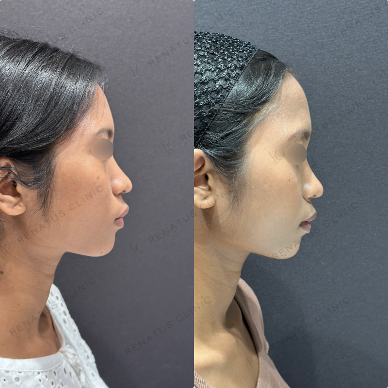 頬コケヒアルロン酸ボライト症例写真