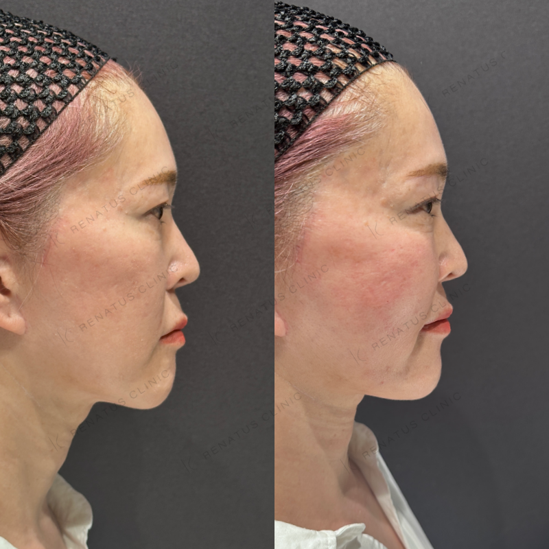 頬コケヒアルロン酸ボライト症例写真