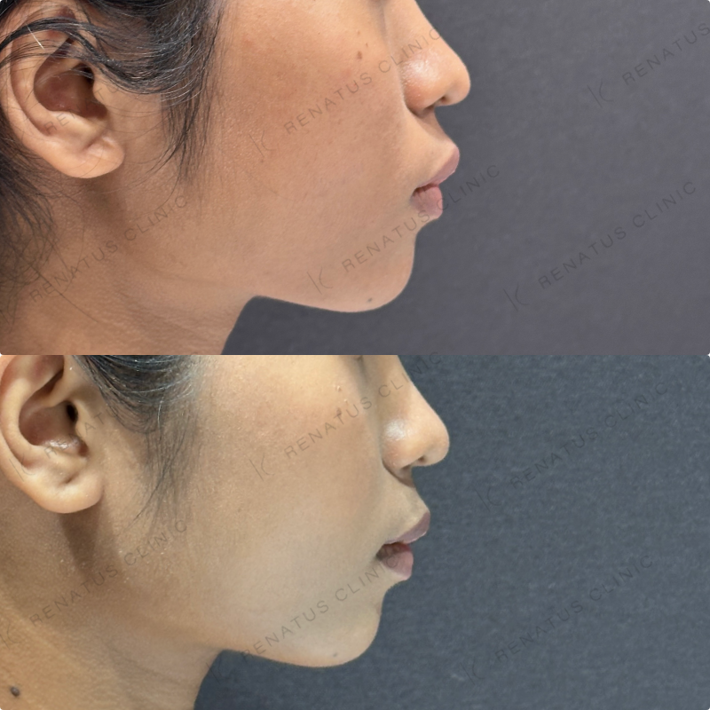 頬コケヒアルロン酸ボライト症例写真