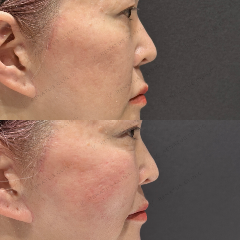 頬コケヒアルロン酸ボライト症例写真