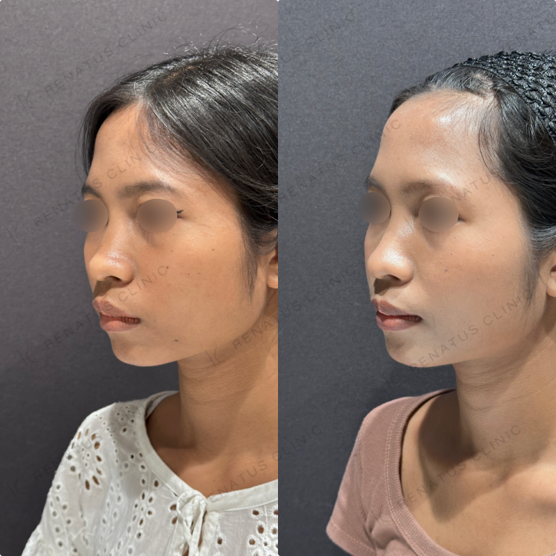 頬コケヒアルロン酸ボライト症例写真