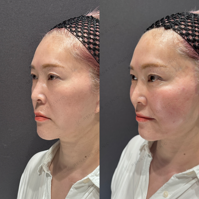 頬コケヒアルロン酸ボライト症例写真