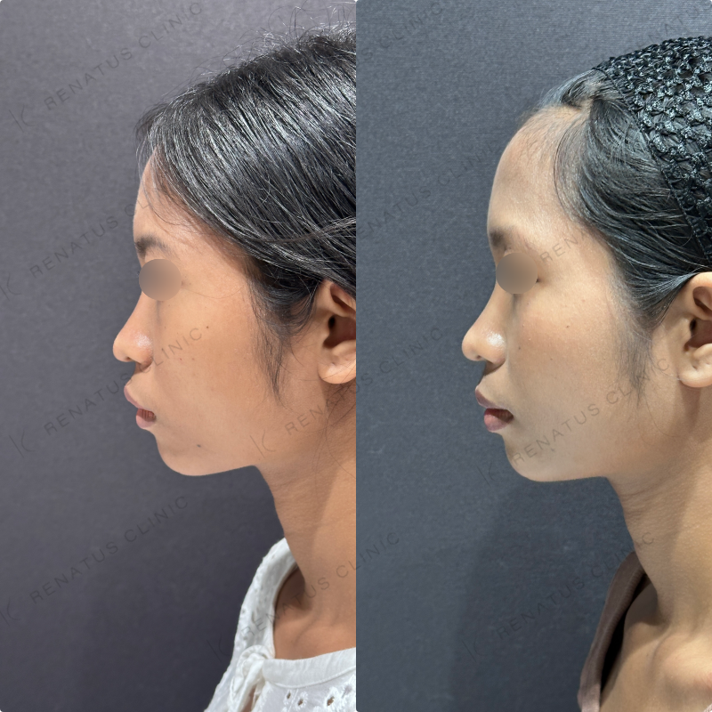 頬コケヒアルロン酸ボライト症例写真