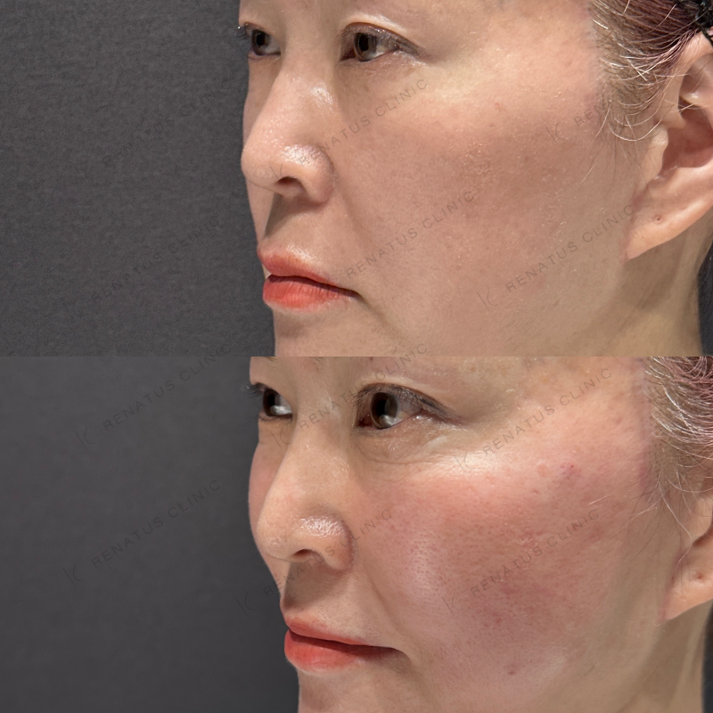 頬コケヒアルロン酸ボライト症例写真