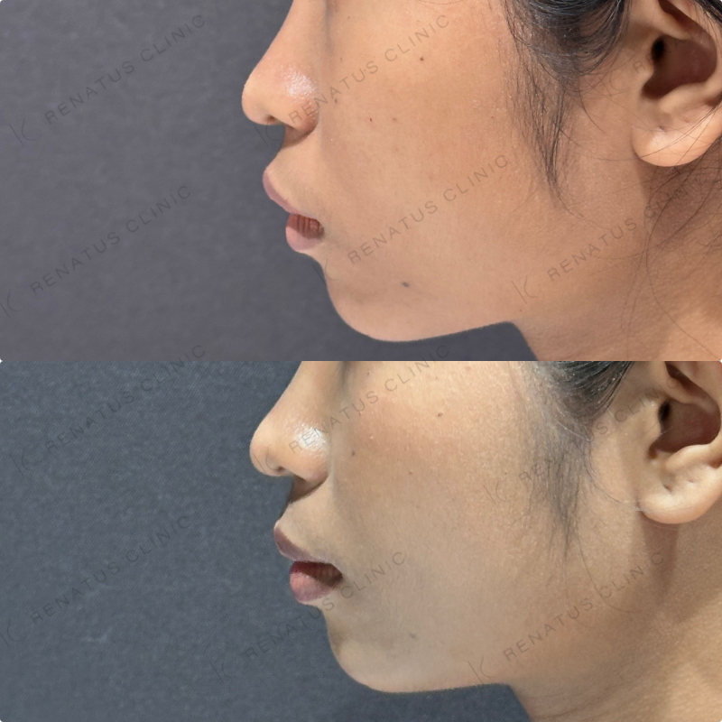 頬コケヒアルロン酸ボライト症例写真