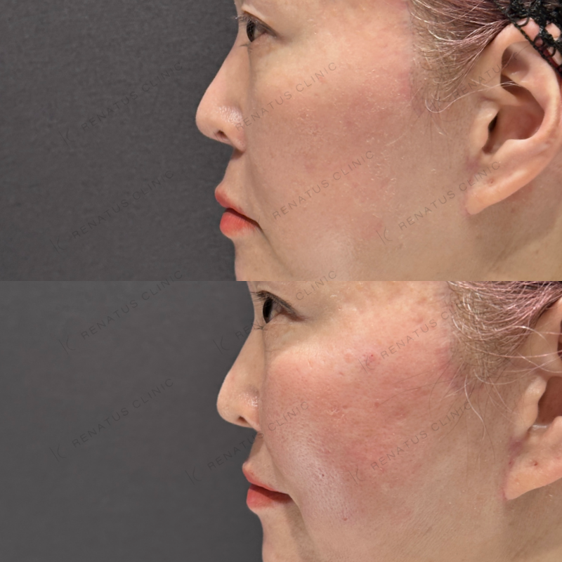 頬コケヒアルロン酸ボライト症例写真