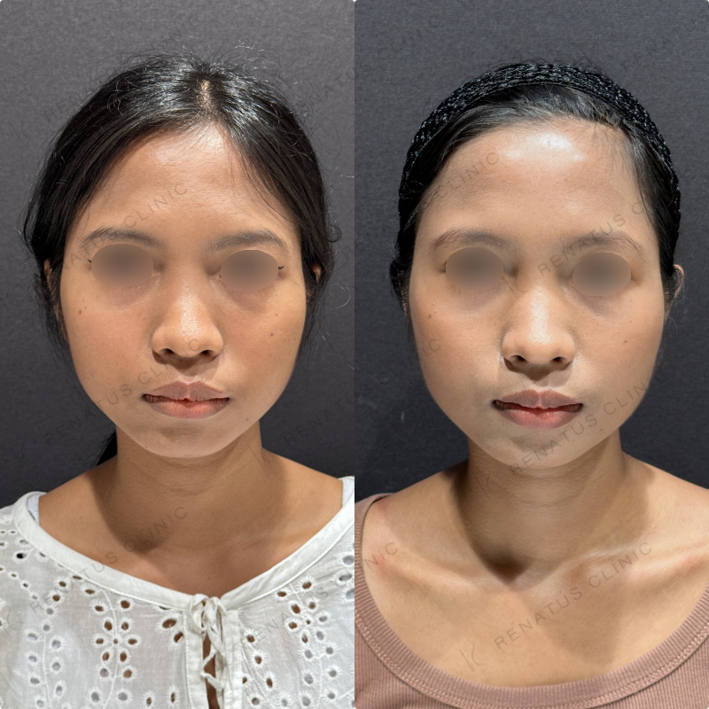 頬コケヒアルロン酸ボライト症例写真