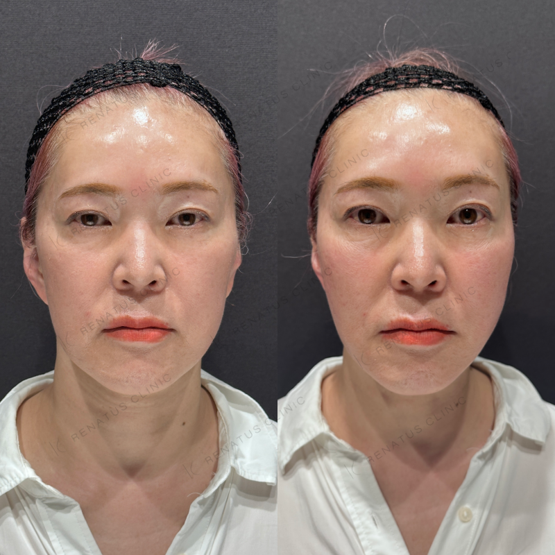 頬コケヒアルロン酸ボライト症例写真