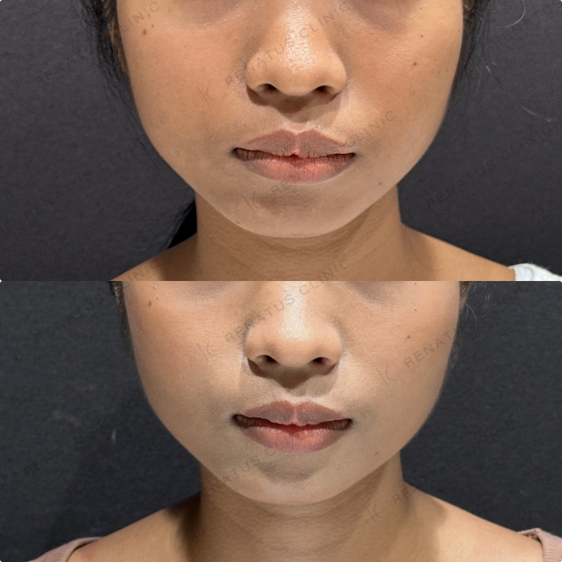 頬コケヒアルロン酸ボライト症例写真