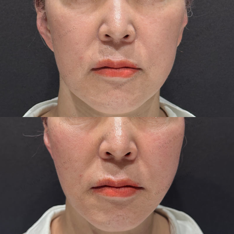 頬コケヒアルロン酸ボライト症例写真