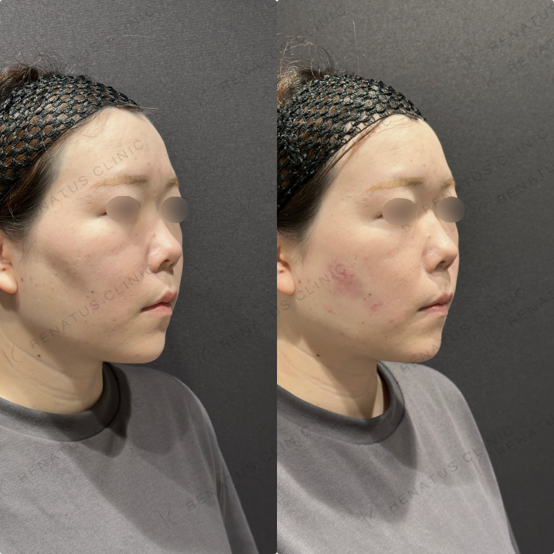 頬コケヒアルロン酸ボリューマ症例写真