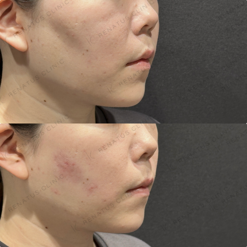 頬コケヒアルロン酸ボリューマ症例写真