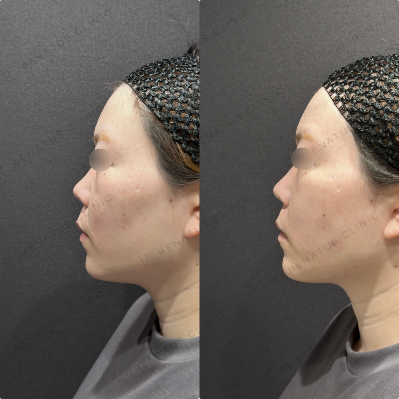 頬コケヒアルロン酸ボリューマ症例写真