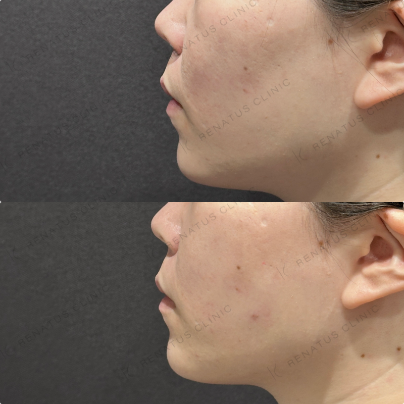 頬コケヒアルロン酸ボリューマ症例写真