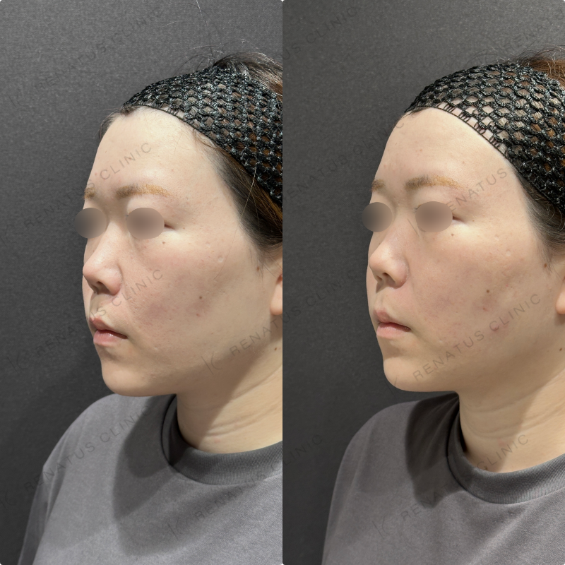 頬コケヒアルロン酸ボリューマ症例写真