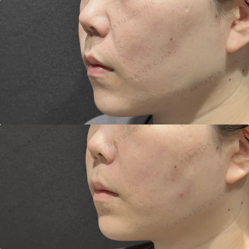 頬コケヒアルロン酸ボリューマ症例写真