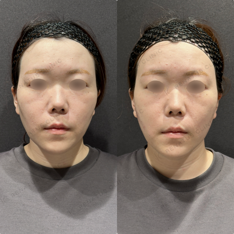 頬コケヒアルロン酸ボリューマ症例写真