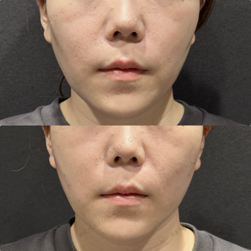 頬コケヒアルロン酸ボリューマ症例写真
