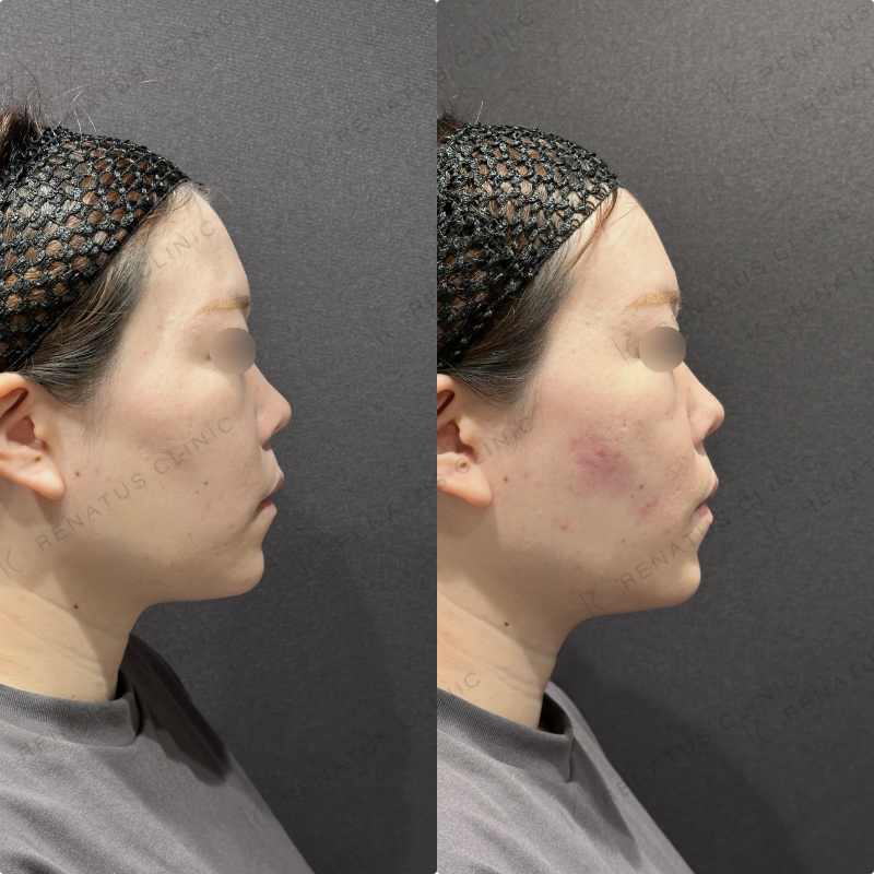 頬コケヒアルロン酸ボリューマ症例写真