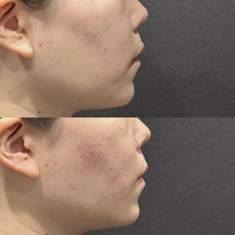 頬コケヒアルロン酸ボリューマ症例写真