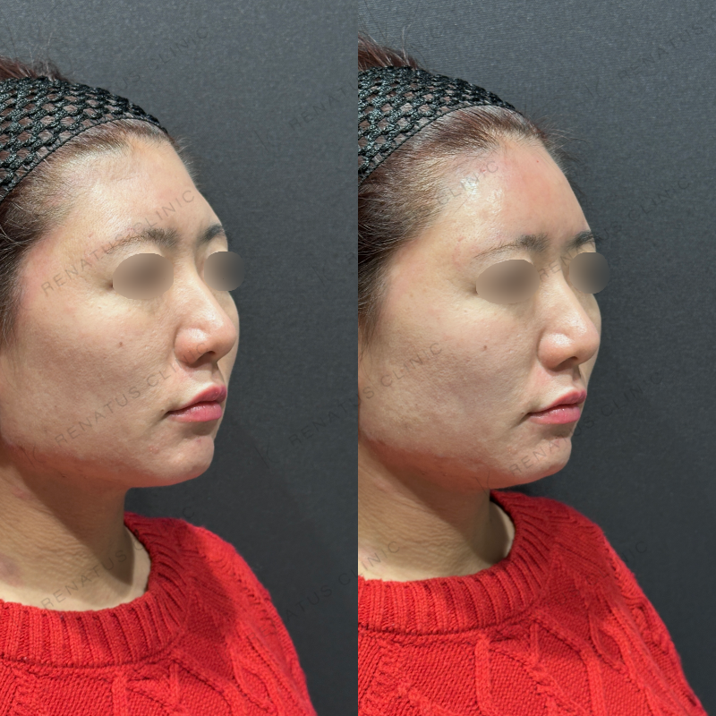 額ヒアルロン酸ボリューマ症例写真