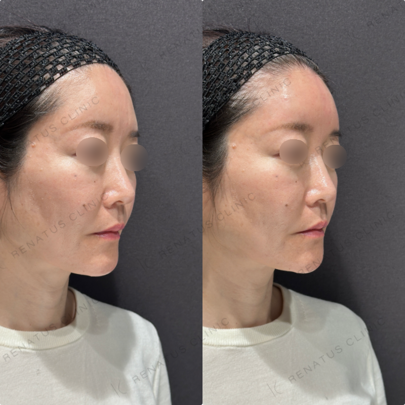 額ヒアルロン酸ボリューマ症例写真