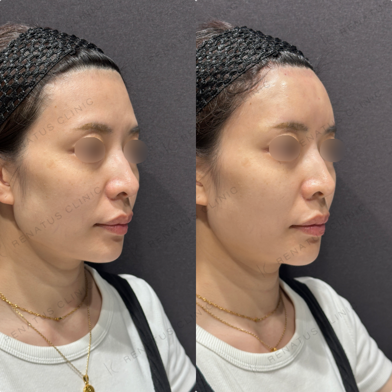 額ヒアルロン酸ボリューマ症例写真