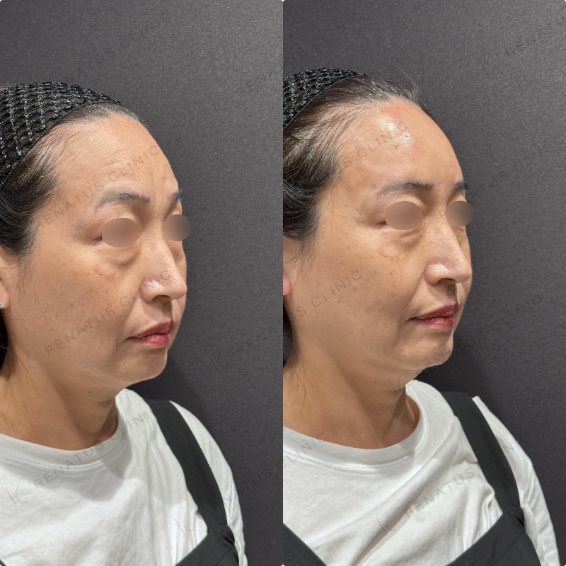 額ヒアルロン酸ボリューマ症例写真