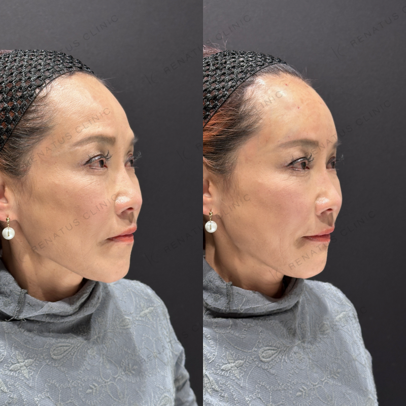 額ヒアルロン酸ボリューマ症例写真