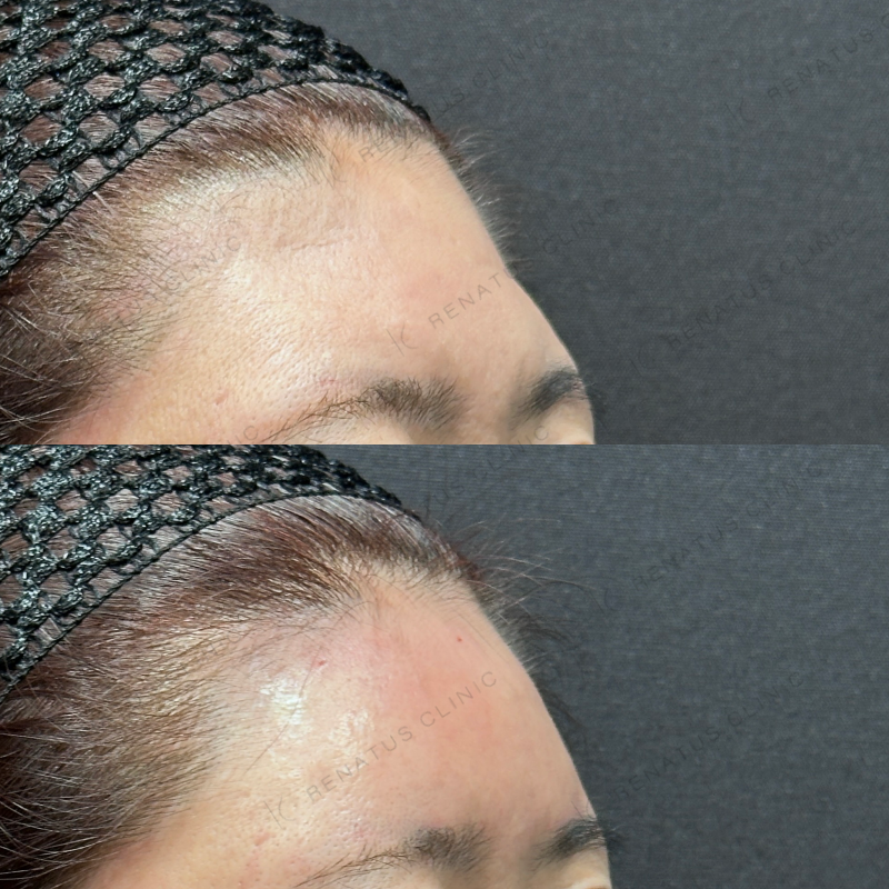 額ヒアルロン酸ボリューマ症例写真