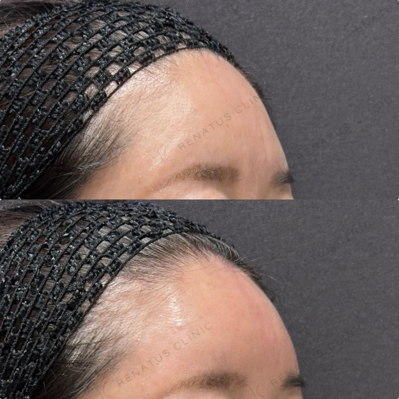 額ヒアルロン酸ボリューマ症例写真