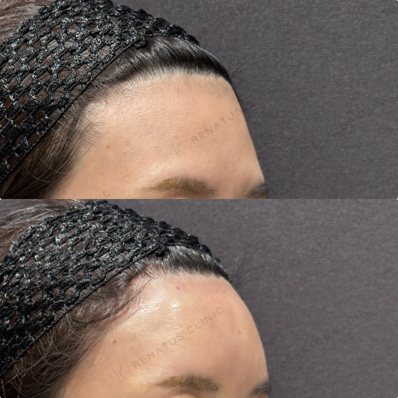 額ヒアルロン酸ボリューマ症例写真