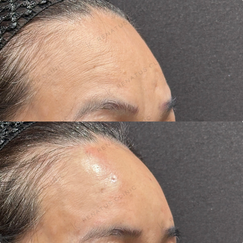 額ヒアルロン酸ボリューマ症例写真