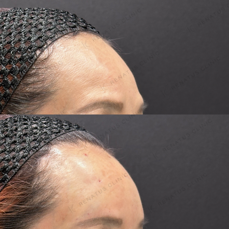 額ヒアルロン酸ボリューマ症例写真