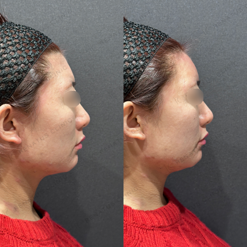 額ヒアルロン酸ボリューマ症例写真