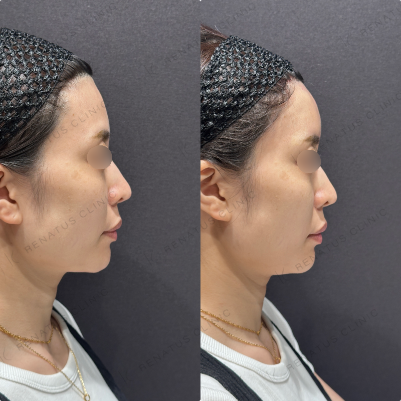 額ヒアルロン酸ボリューマ症例写真