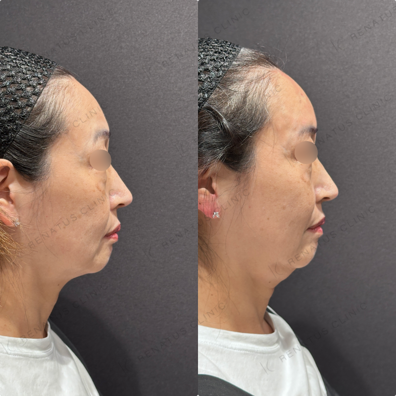 額ヒアルロン酸ボリューマ症例写真